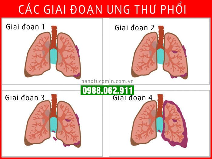 Các giai đoạn ung thư phổi